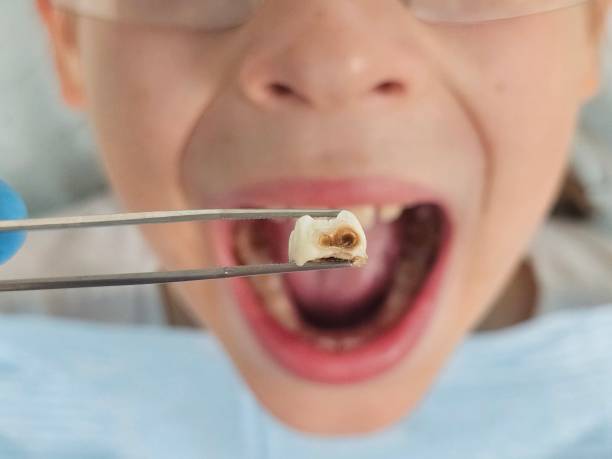 Best Dentist for Tooth Abscess  in Spencer, OK